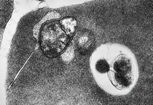 M,30y. | blood - dyserythropoetic anemia M,30y. | blood - dyserythropoetic anemia